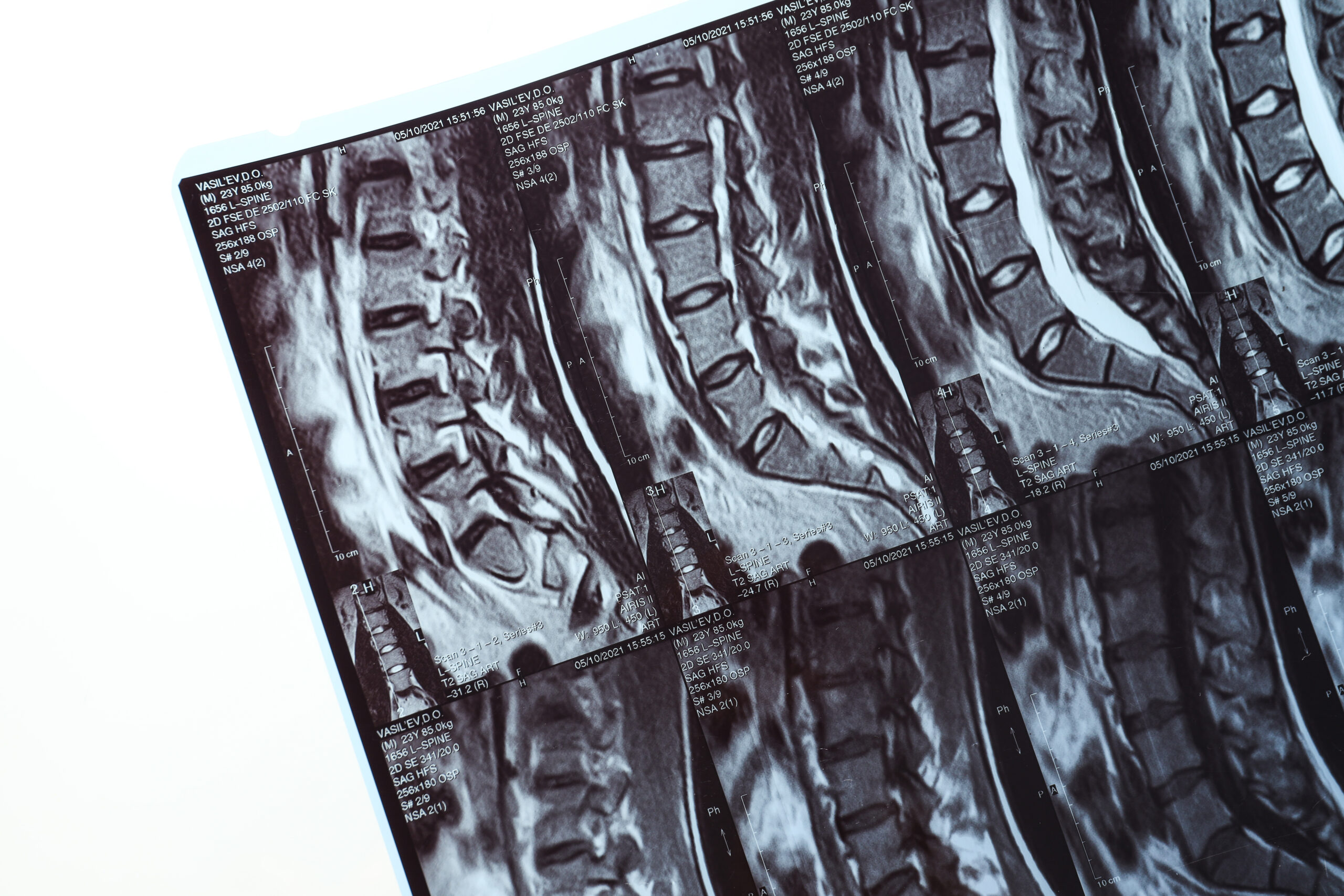 MRI or magnetic resonance imaging of the human spine. Close-up